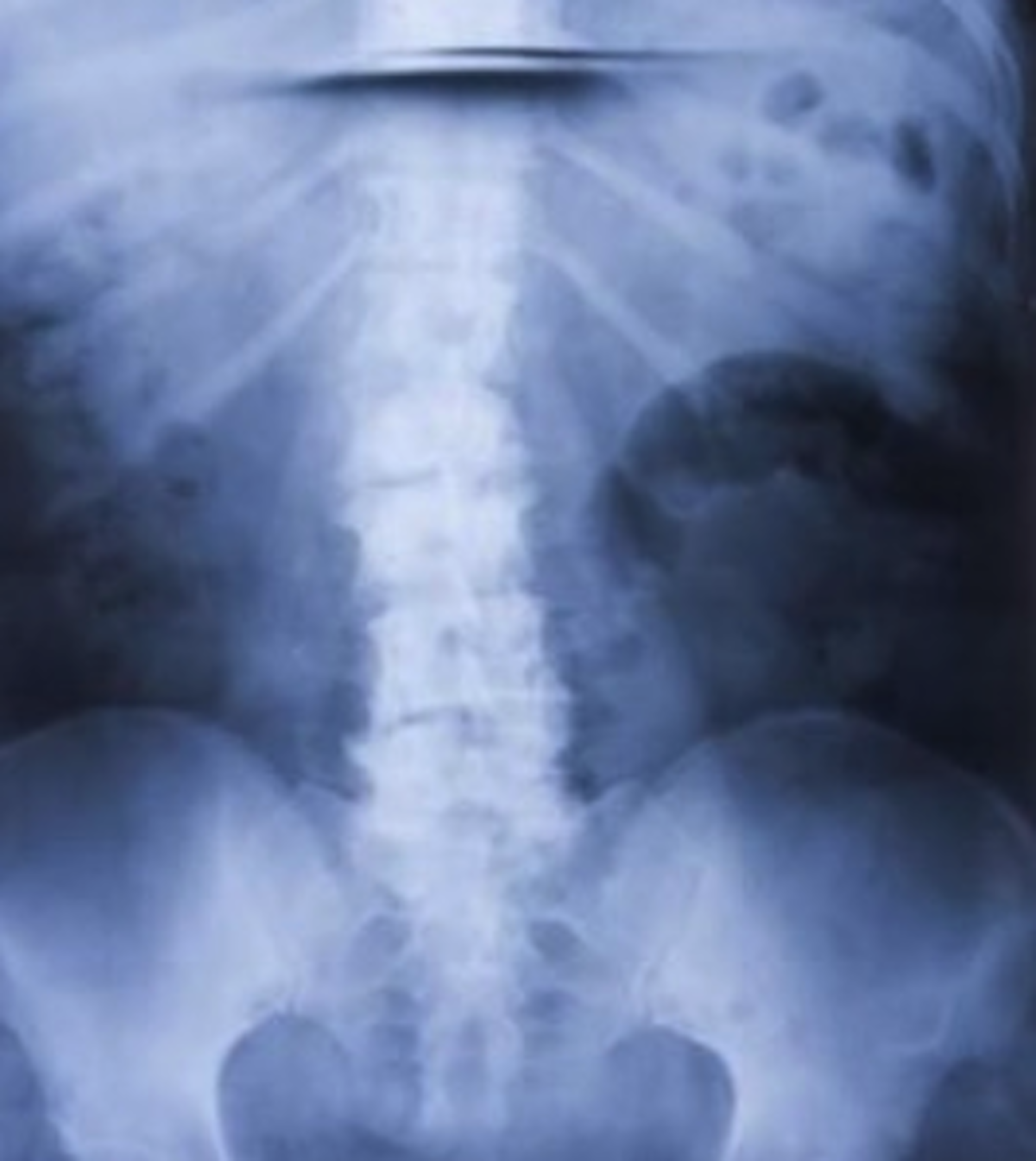 x-ray of spinal chord and discs