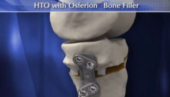 hto osferion bone filler