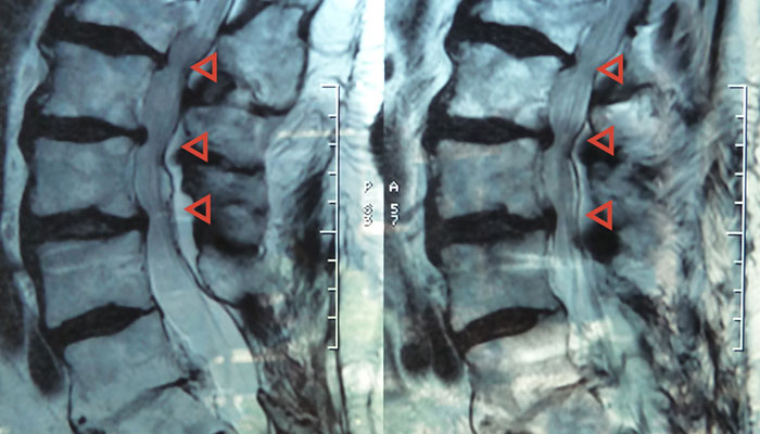 spinal stenosis